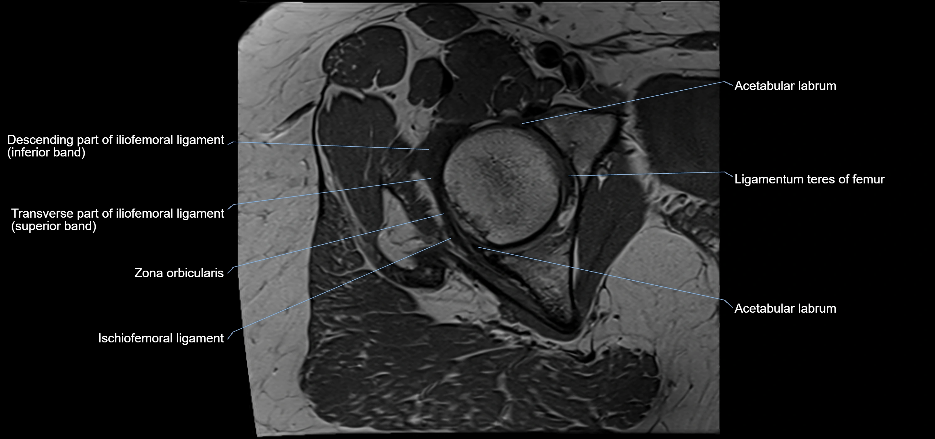 Hip ligament anatomy axial 3T MRI image -img-13001-00015.webp